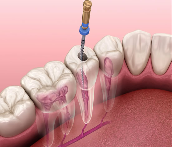 root canal therapy
