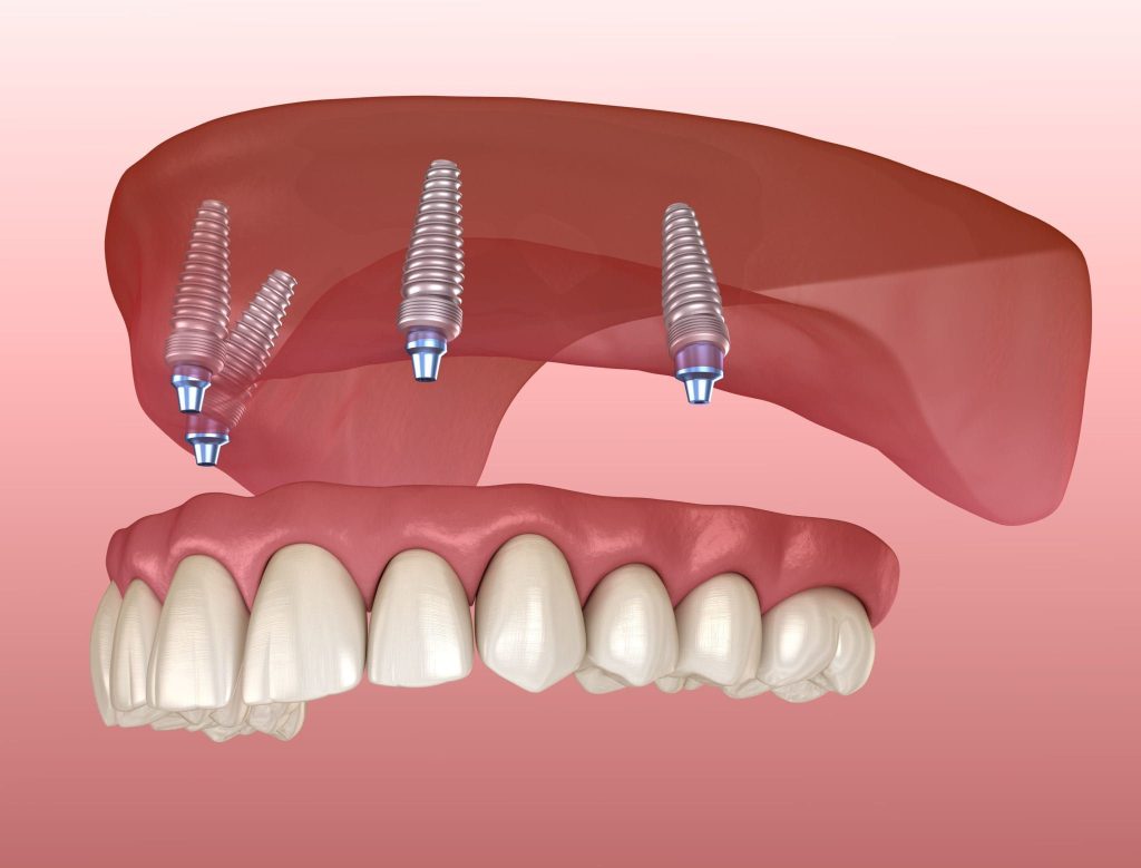 dentures near me