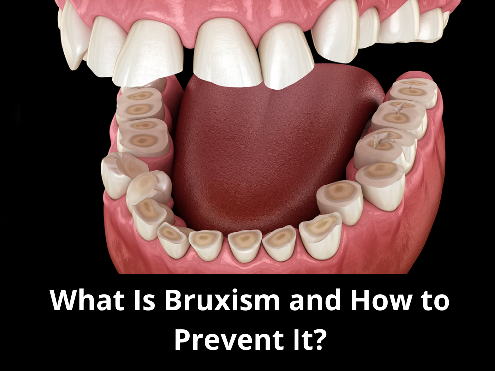 What Is Bruxism and How to Prevent It