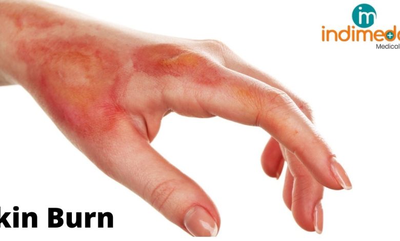 Skin Burn