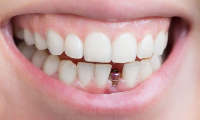 loose dental crowns