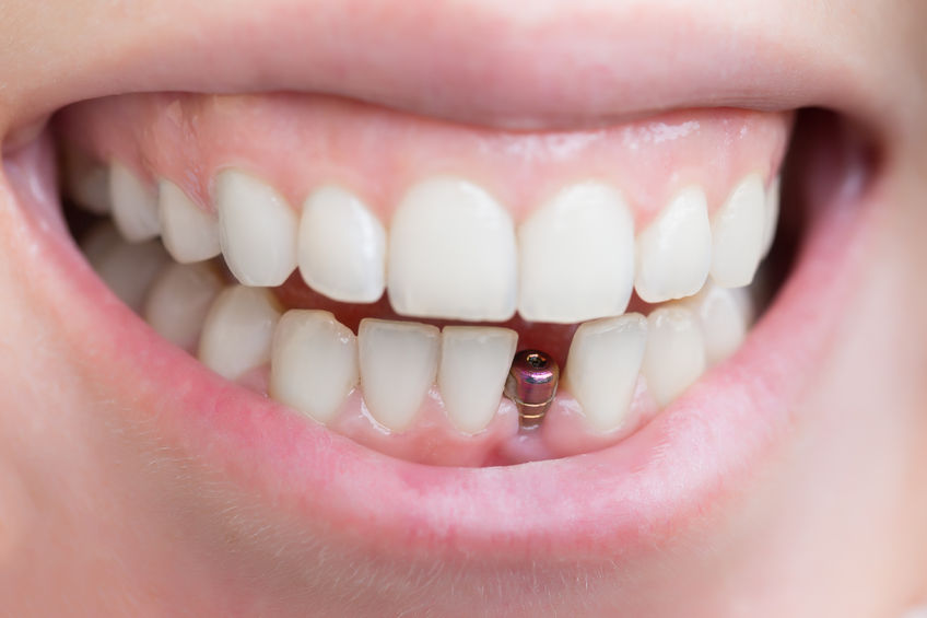 loose dental crowns